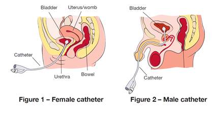 Urinary Catheter